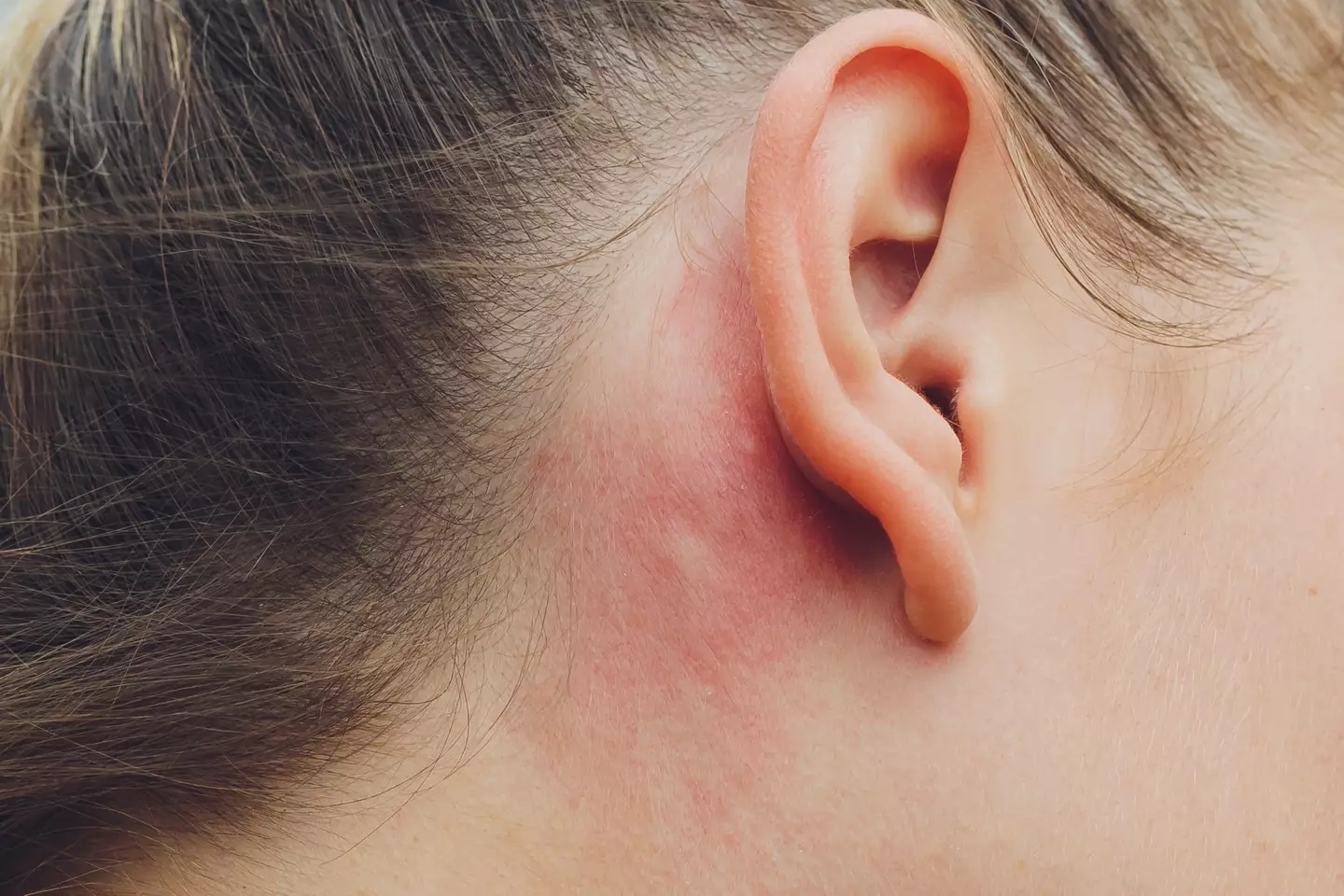 patch test 